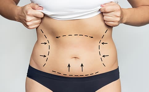 Abdominoplastia (cirugía de abdomen)
