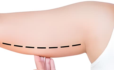 Braquiplastia (cirugía de reducción de brazos)